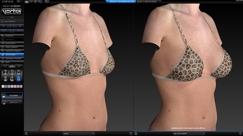 VECTRA® 3D Imaging for Laser Bra Breast Surgery