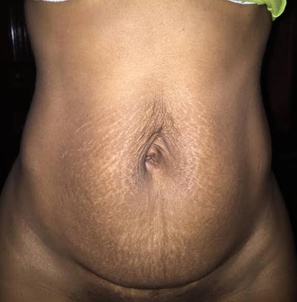 Tummy Tuck before actual patient