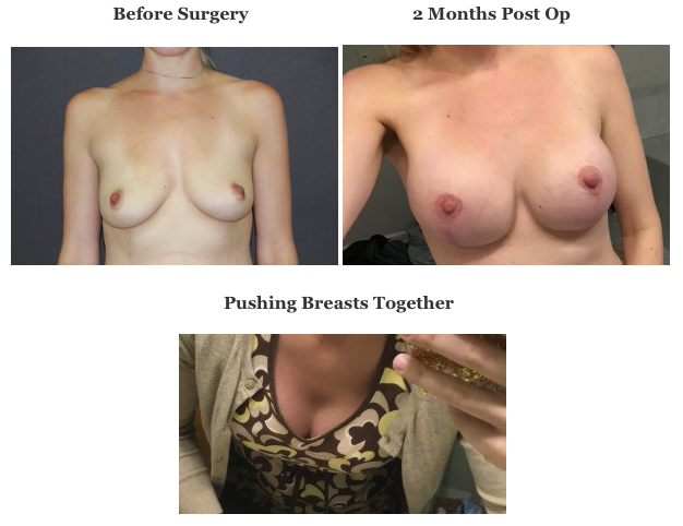 Pre Op and Post Op Photos and Photo of Breasts Pushed Together