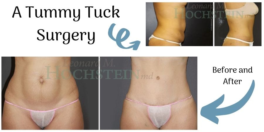 Is A Tummy Tuck Surgery For You?