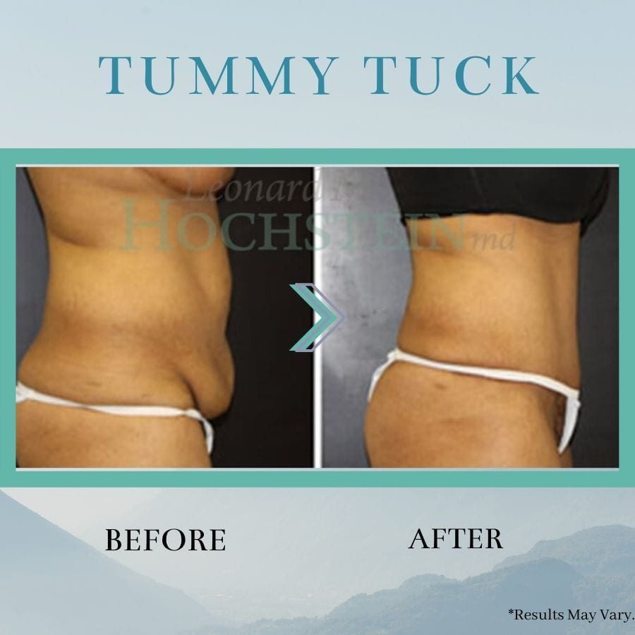 Liposuction vs. Tummy Tuck for a Flat Stomach