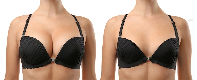 How Small Can My Breast Reduction Go?